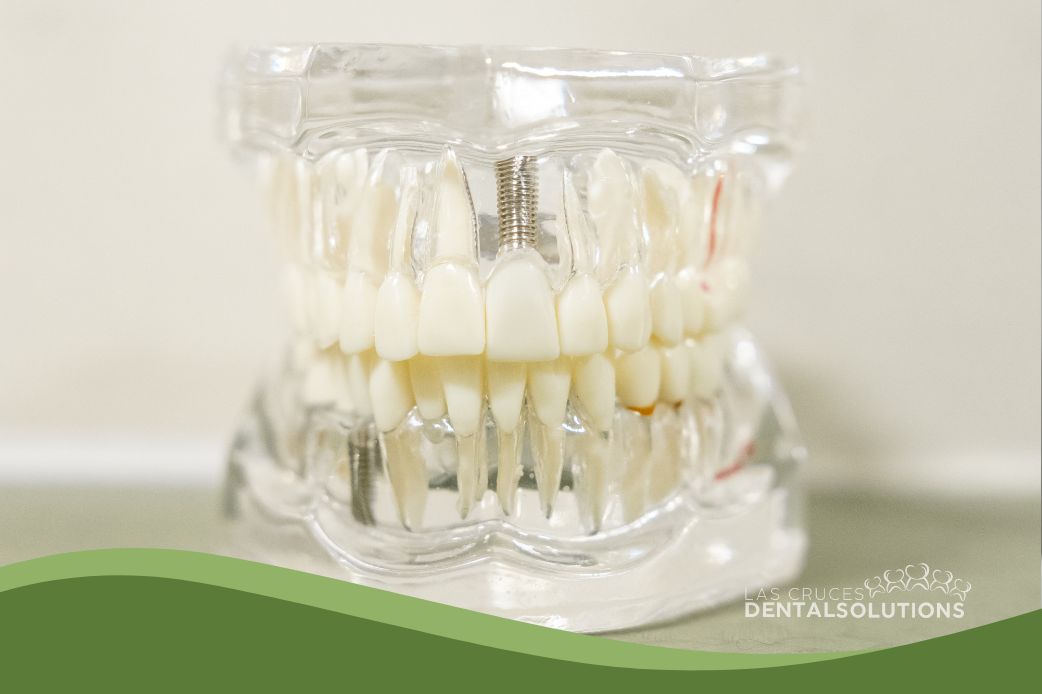 The Long-Term Benefits of Dental Implants You Shouldn’t Overlook